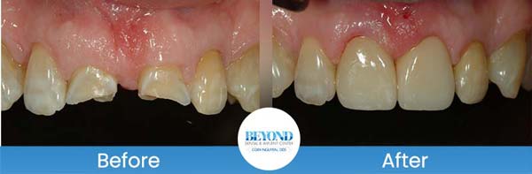 Porcelain Veneers Smile Gallery Near Me in Los Altos, CA