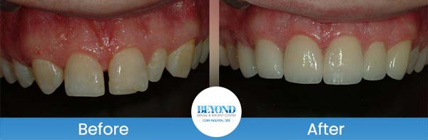 Porcelain Veneers Smile Gallery Near Me in Los Altos, CA