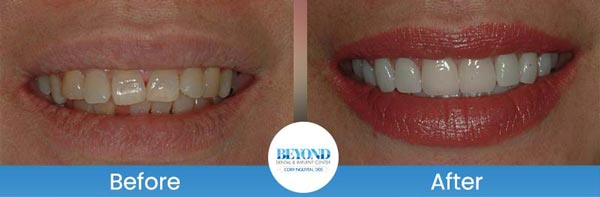 Porcelain Veneers Smile Gallery Near Me in Los Altos, CA