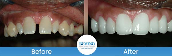 Porcelain Veneers Smile Gallery Near Me in Los Altos, CA