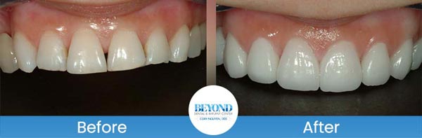 Porcelain Veneers Smile Gallery Near Me in Los Altos, CA