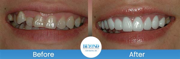 Porcelain Veneers Smile Gallery Near Me in Los Altos, CA