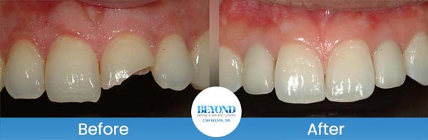 Porcelain Veneers Smile Gallery Near Me in Los Altos, CA