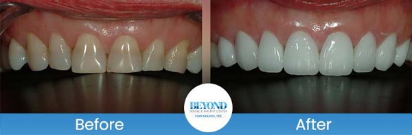 Porcelain Veneers Smile Gallery Near Me in Los Altos, CA