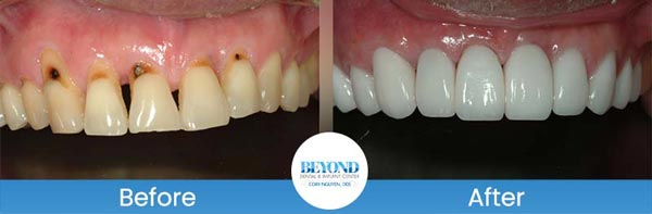 Porcelain Veneers Smile Gallery Near Me in Los Altos, CA