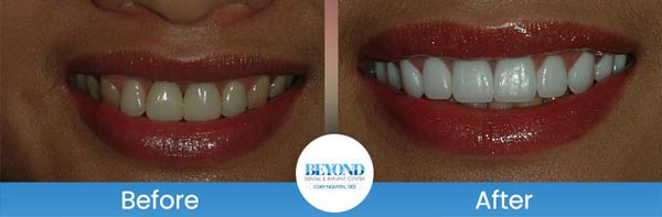 Porcelain Veneers Smile Gallery Near Me in Los Altos, CA