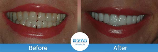 Porcelain Veneers Smile Gallery Near Me in Los Altos, CA