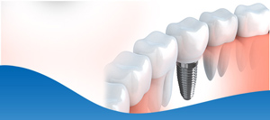 Who Does Dental Implants in Los Altos, CA?