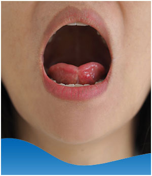 Tongue Tie Surgery Near Me in Los Altos, CA