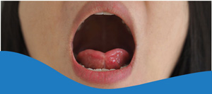 Tongue Tie Surgery Specialist Near Me in Los Altos, CA Tongue Tie Surgery Specialist Near Me in Los Altos, CA