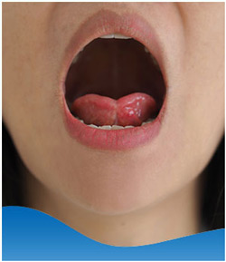 Tongue Tie Surgery Near Me in Los Altos, CA