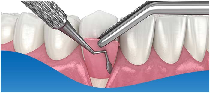 Dental Bone Grafting Specialist Near Me in DFW Area Dental Bone Grafting Specialist Near Me in DFW Area