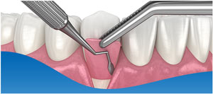 Dental Bone Grafting Specialist Near Me in DFW Area Dental Bone Grafting Specialist Near Me in DFW Area