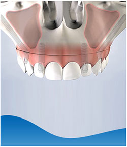 Zygomatic Implants Near Me in Los Altos, CA