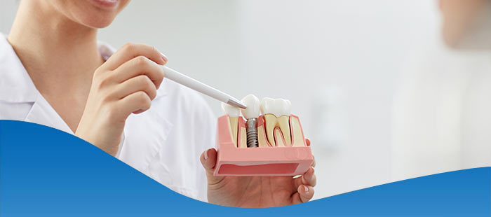 Full Mouth Dental Implants Dentist Near Me in Los Altos, CA Full Mouth Dental Implants Dentist Near Me in Los Altos, CA