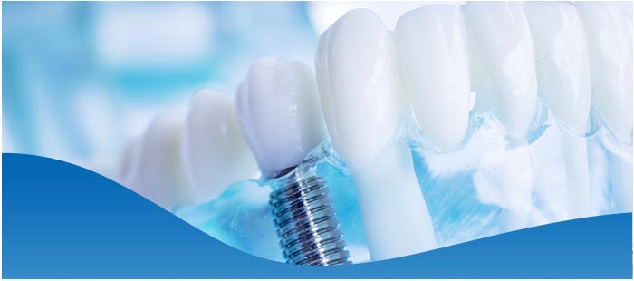 Top-Rated All-On-4 Dental Implants Dentist Near Me in Los Altos, CA
