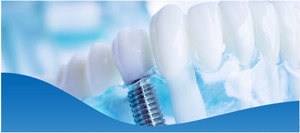 Top-Rated All-On-4 Dental Implants Dentist Near Me in Los Altos, CA