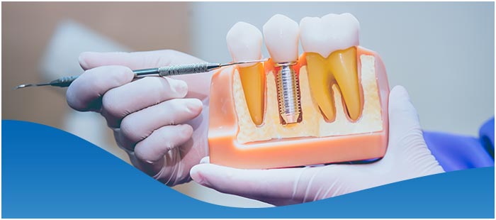Lifespan of Dental Implants Near Me in Los Altos, CA Lifespan of Dental Implants Near Me in Los Altos, CA