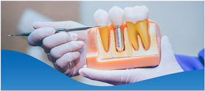 Lifespan of Dental Implants Near Me in Los Altos, CA Lifespan of Dental Implants Near Me in Los Altos, CA