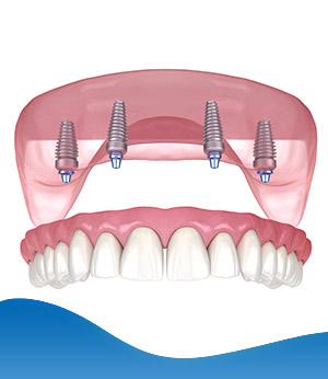 Pterygoid Implants Near Me in Los Altos, CA