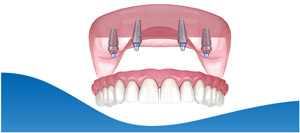 Pterygoid Implants Specialist Near Me in Los Altos, CA Pterygoid Implants Specialist Near Me in Los Altos, CA