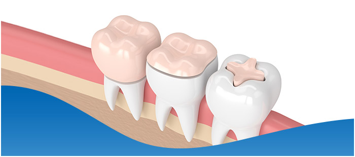 Types of Dental Implants Near Me in Los Altos, CA Types of Dental Implants Near Me in Los Altos, CA