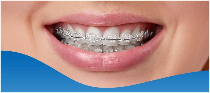 Cost of Braces Near Me in Los Altos, CA Cost of Braces Near Me in Los Altos, CA