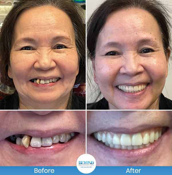 All-on-4 Implants Specialist Near Me in Los Altos, CA