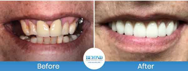 All-on-4 Implants Specialist Near Me in Los Altos, CA