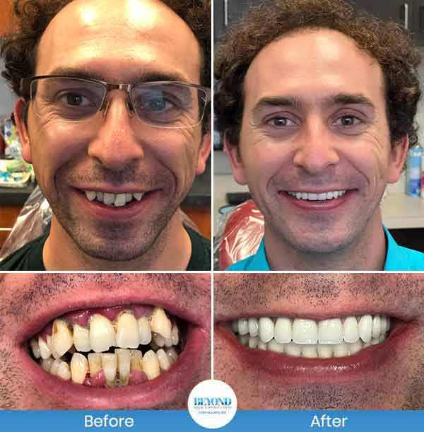 All-on-4 Implants Specialist Near Me in Los Altos, CA