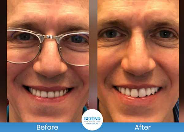 All-on-4 Implants Specialist Near Me in Los Altos, CA