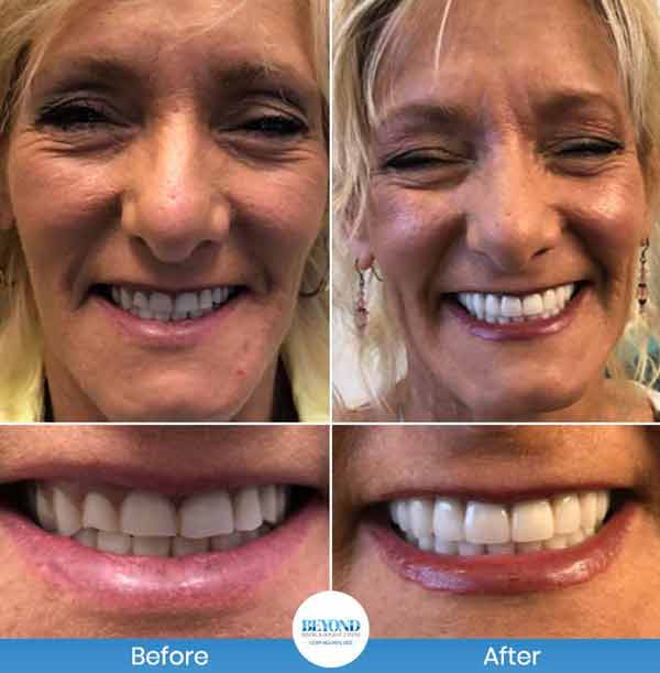 All-on-4 Implants Specialist Near Me in Los Altos, CA