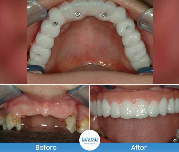 All-on-4 Implants Specialist Near Me in Los Altos, CA