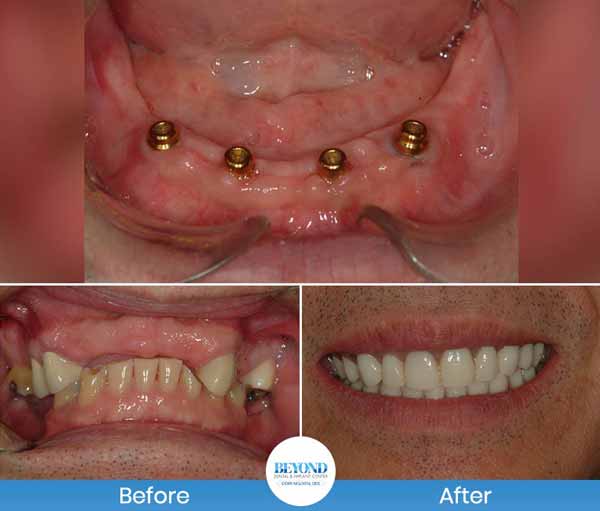 All-on-4 Implants Specialist Near Me in Los Altos, CA