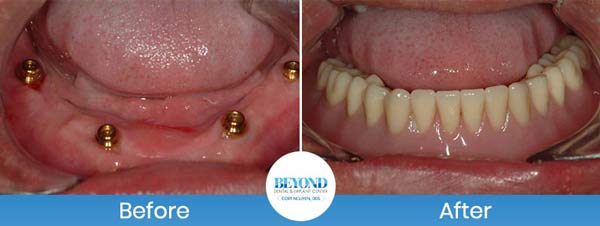 All-on-4 Implants Specialist Near Me in Los Altos, CA