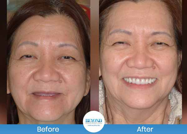 All-on-4 Implants Specialist Near Me in Los Altos, CA