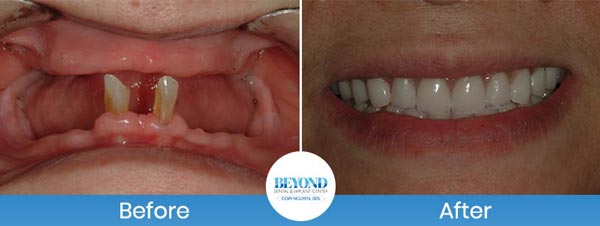 All-on-4 Implants Specialist Near Me in Los Altos, CA