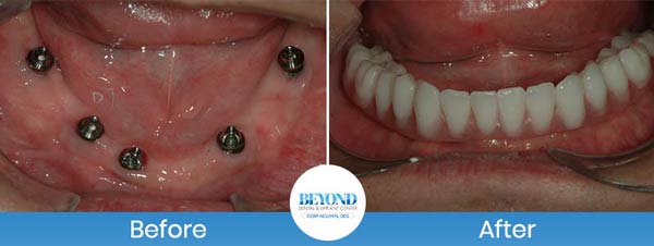 All-on-4 Implants Specialist Near Me in Los Altos, CA