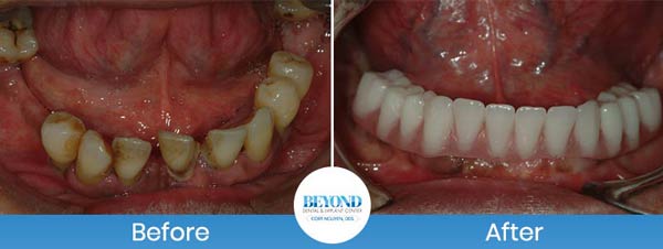 All-on-4 Implants Specialist Near Me in Los Altos, CA