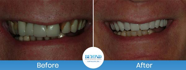 All-on-4 Implants Specialist Near Me in Los Altos, CA