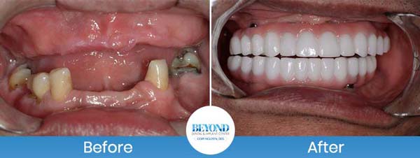 All-on-4 Implants Specialist Near Me in Los Altos, CA