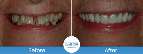 All-on-4 Implants Specialist Near Me in Los Altos, CA