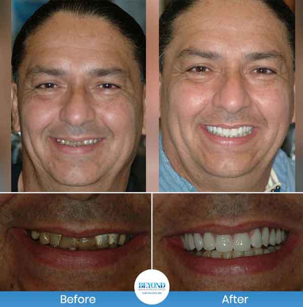 All-on-4 Implants Specialist Near Me in Los Altos, CA