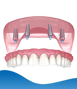 Pterygoid Implants Near Me in Los Altos, CA