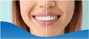 Tooth Contouring Specialist Near Me in Los Altos, CA Tooth Contouring Specialist Near Me in Los Altos, CA