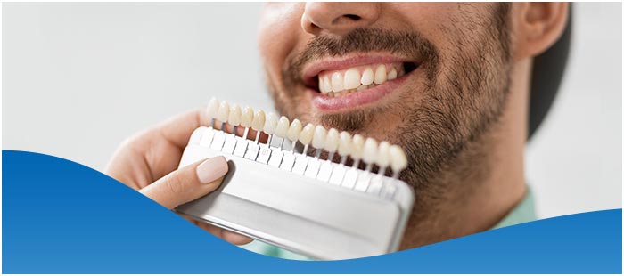 Cost of Veneers Per Tooth Near Me in Los Altos, CA Cost of Veneers Per Tooth Near Me in Los Altos, CA