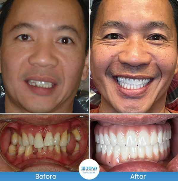 All-on-4 Implants Specialist Near Me in Los Altos, CA