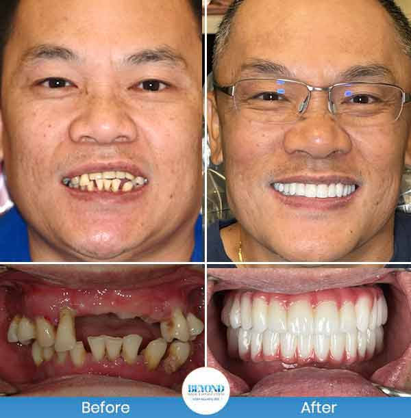 All-on-4 Implants Specialist Near Me in Los Altos, CA