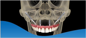4 Questions to Ask About Zygomatic Dental Implants in Los Altos, CA
