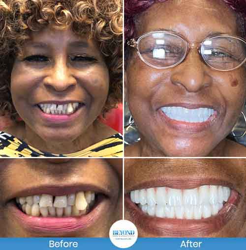 All-on-4 Implants Specialist Near Me in Los Altos, CA and Fort Worth TX